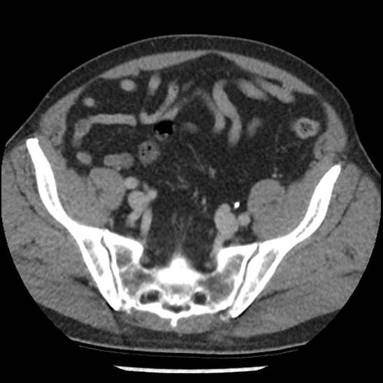 Aortic intramural hematoma (type B) (Radiopaedia 79323-92387 Axial C+ delayed 96).jpg