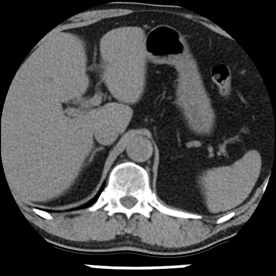 File:Aortic intramural hematoma (type B) (Radiopaedia 79323-92387 Axial non-contrast 54).jpg