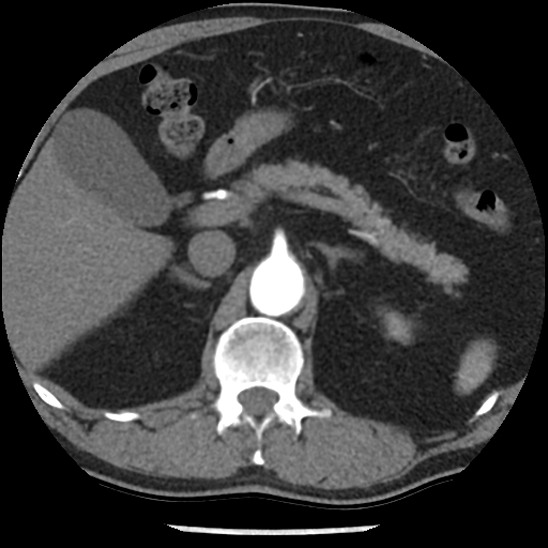 Aortic intramural hematoma (type B) (Radiopaedia 79323-92387 B 60).jpg