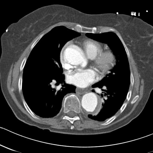 Aortic intramural hematoma from penetrating atherosclerotic ulcer (Radiopaedia 31137-31836 A 47).jpg