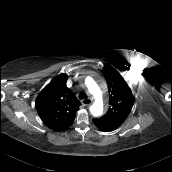Aortic intramural hematoma with dissection and intramural blood pool (Radiopaedia 77373-89491 B 41).jpg