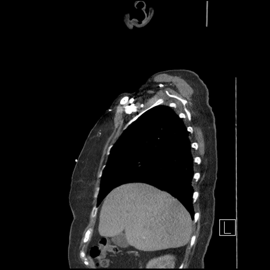 File:Aortic intramural hematoma with dissection and intramural blood pool (Radiopaedia 77373-89491 D 16).jpg