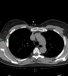 Aortic valve endocarditis (Radiopaedia 87209-103485 Axial non-contrast 32).jpg