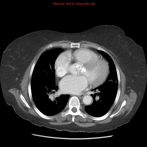 File:Aortic valve stenosis (Radiopaedia 14480-14423 C 7).jpg