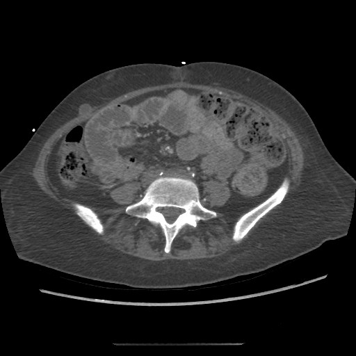 Aorto-duodenal fistula (Radiopaedia 25668-25850 A 52).jpg