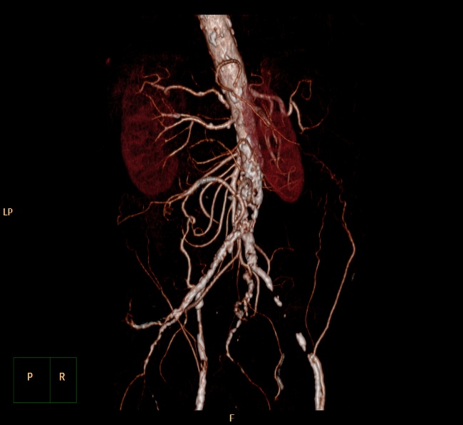 File:Aortoiliac occlusive disease (Radiopaedia 32134-33076 VR C+ arterial phase 7).jpg