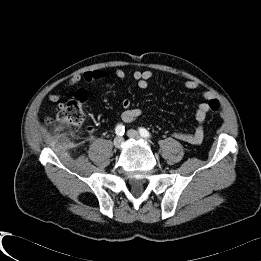 Appendiceal adenocarcinoma complicated by retroperitoneal abscess (Radiopaedia 58007-65039 B 96).jpg