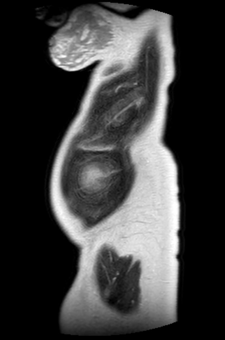 Appendicitis in gravida (MRI) (Radiopaedia 89433-106395 Sagittal T2 5).jpg