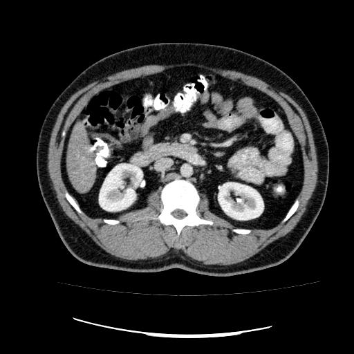 File:Appendicitis with diverticulosis (Radiopaedia 47693-52383 Axial C+ 59).jpg