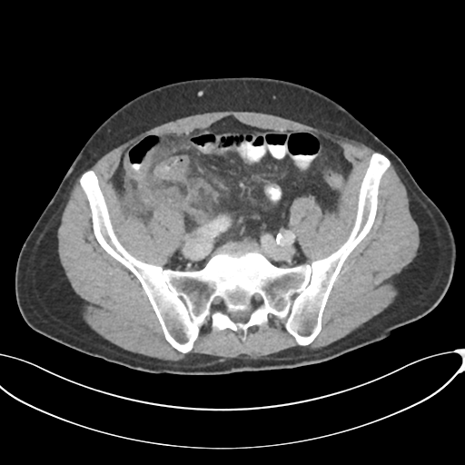 Appendicitis with thickening of the terminal ileum (Radiopaedia 42432-45550 A 73).png