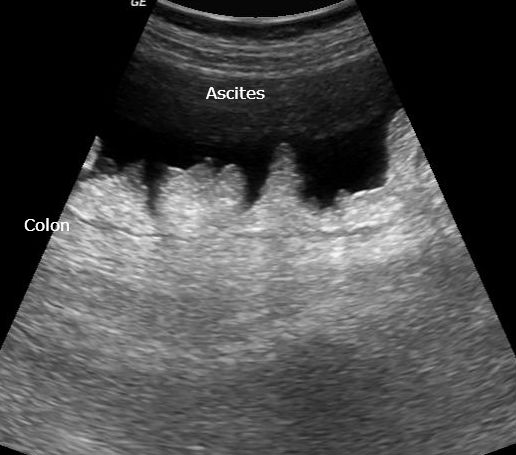 File:Appendix epiploica (Radiopaedia 30827-31540 A 1).jpg