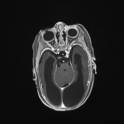 Aqueductal stenosis (Radiopaedia 73974-84802 Axial T1 C+ 63).jpg