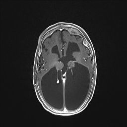 Aqueductal stenosis (Radiopaedia 73974-84802 Axial T1 C+ 85).jpg