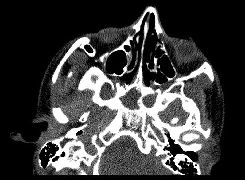 Arachnoid cyst- extremely large (Radiopaedia 68741-78450 Axial bone window 4).jpg