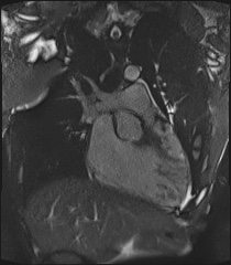 Arrhythmogenic right ventricular cardiomyopathy (Radiopaedia 57972-64966 CINE R2 SSFP 2).jpg