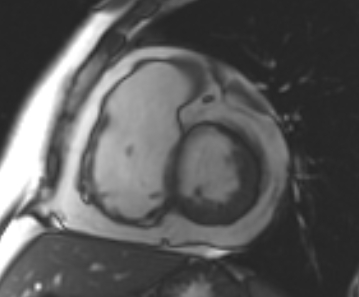 Arrhythmogenic right ventricular cardiomyopathy (Radiopaedia 69431-79307 Short axis cine 151).jpg