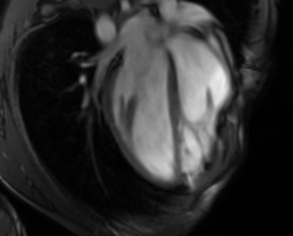 Arrhythmogenic right ventricular cardiomyopathy (Radiopaedia 69564-79464 4ch cine 57).jpg