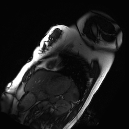 File:Arrhythmogenic right ventricular cardiomyopathy (Radiopaedia 87505-103850 short axis Cine SSFP 29).jpg