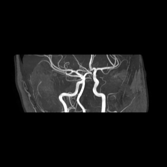 File:Artery of Percheron infarct (Radiopaedia 40966-43676 G 23).jpg
