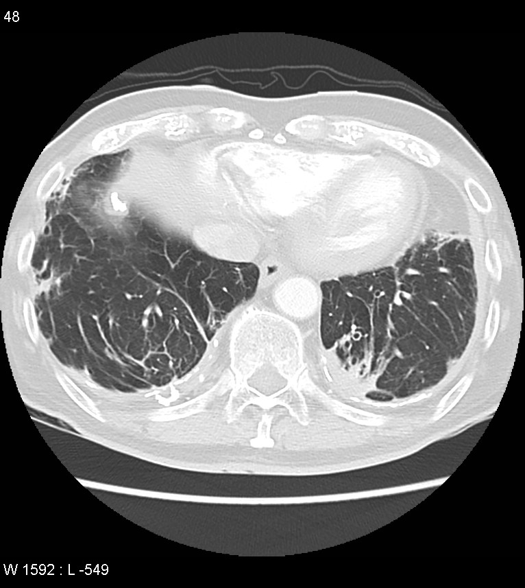 Asbestos related lung and pleural disease (Radiopaedia 14377-14301 A 45).jpg