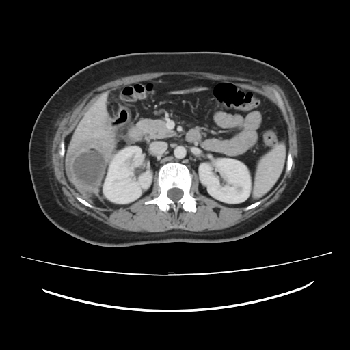 Ascending retrocecal appendicitis with liver abscesses (Radiopaedia 60066-67615 B 37).jpg