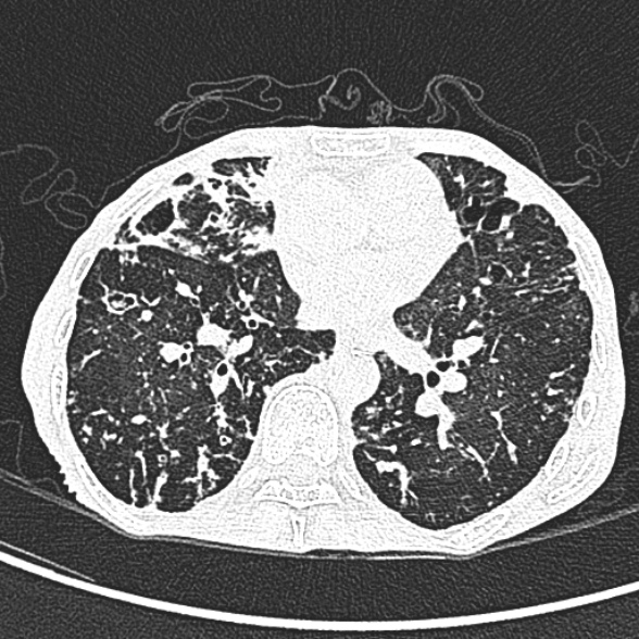Aspergilloma- with Monod sign (Radiopaedia 44737-48532 Axial lung window 160).jpg