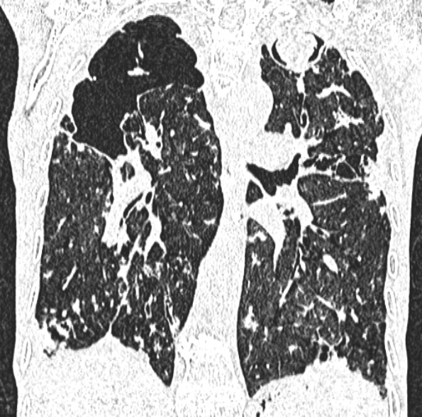 Aspergilloma- with Monod sign (Radiopaedia 44737-48532 Coronal lung window 284).jpg