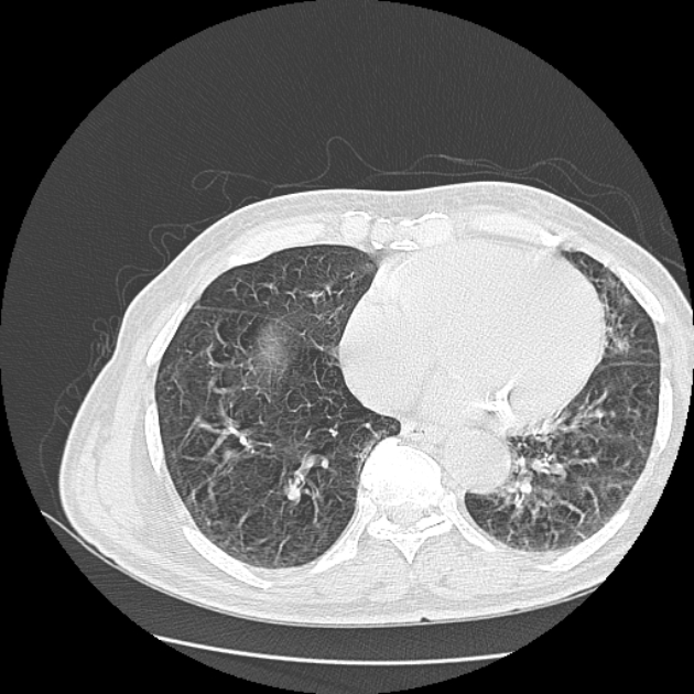 Aspergilloma (Radiopaedia 44592-48327 Axial lung window 64).jpg
