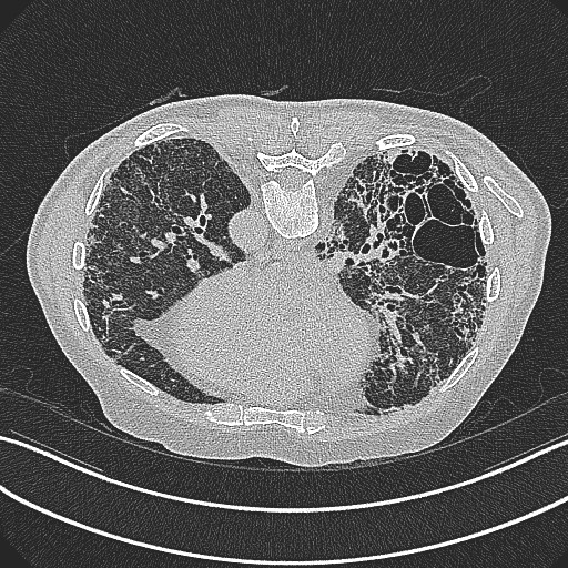 File:Aspergilloma on background pulmonary fibrosis (Radiopaedia 60942-68757 Axial lung window 15).jpg