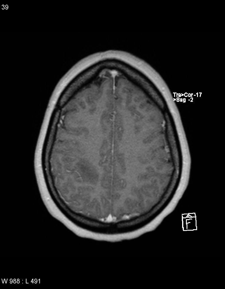 Astroblastoma (Radiopaedia 39792-42217 Axial T1 C+ 38).jpg