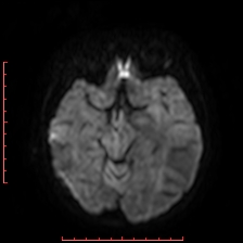 Astroblastoma (Radiopaedia 74287-85162 Axial DWI 37).jpg