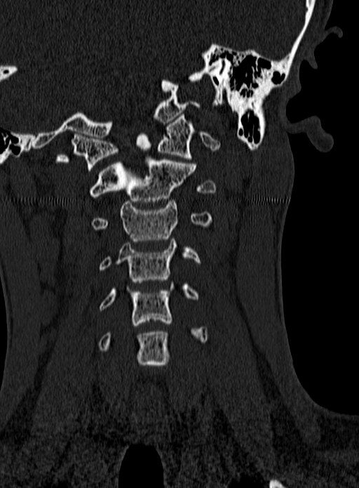 Atlantoaxial subluxation (Radiopaedia 44681-48450 Coronal bone window 41).jpg