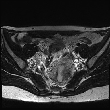 File:Atypical deep infiltrating endometriosis (Radiopaedia 44470-48125 Axial T2 10).jpg