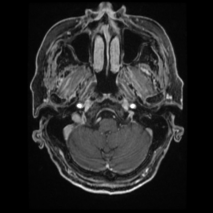 Atypical meningioma (Radiopaedia 45535-49629 Axial T1 C+ 20).jpg