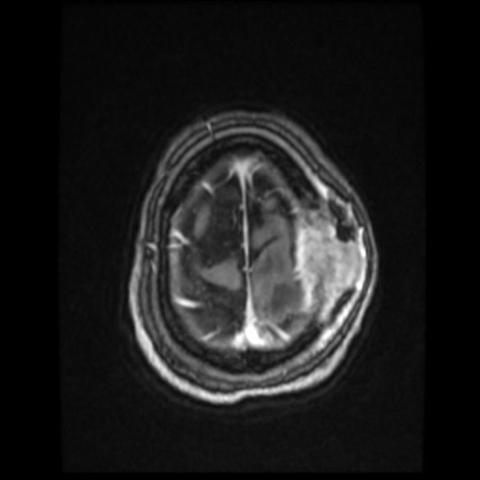 Atypical meningioma (Radiopaedia 45535-49629 Axial T1 C+ 59).jpg