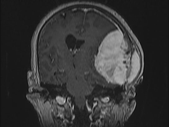 Atypical meningioma (Radiopaedia 62985-71406 Coronal T1 C+ 64).jpg