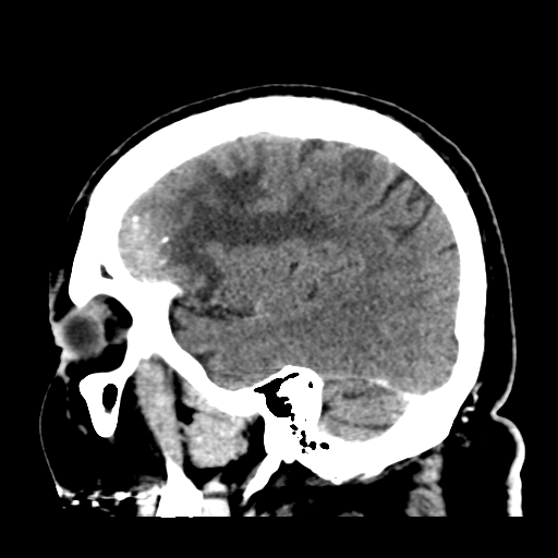 Atypical meningioma (WHO grade II) with brain invasion (Radiopaedia 57767-64728 Sagittal C+ 12).png