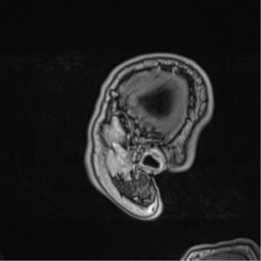 Atypical meningioma (WHO grade II) with brain invasion (Radiopaedia 57767-64729 Sagittal T1 C+ 11).png