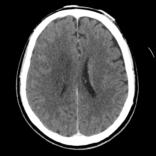 Atypical meningioma with skull invasion (Radiopaedia 34357-35649 Axial C+ delayed 33).png