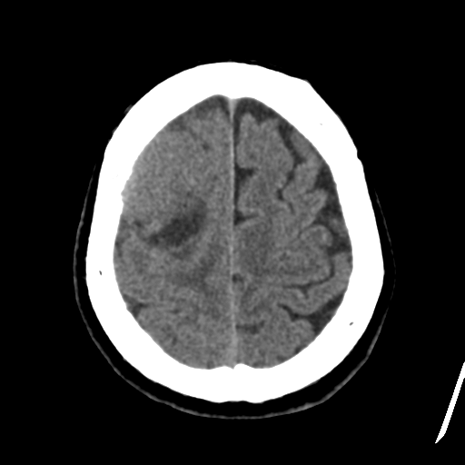 Atypical meningioma with skull invasion (Radiopaedia 34357-35649 Axial non-contrast 43).png