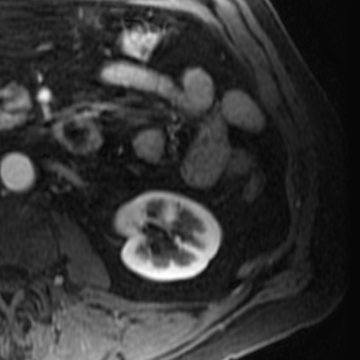 File:Atypical renal cyst on MRI (Radiopaedia 17349-17046 C 21).jpg