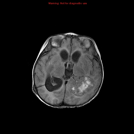 File:Atypical teratoid rhabdoid tumor (Radiopaedia 10712-11183 Axial FLAIR 9).jpg