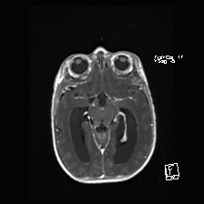Atypical teratoid rhabdoid tumor (prenatal US and neonatal MRI) (Radiopaedia 59091-66388 Axial T1 C+ 27).jpg