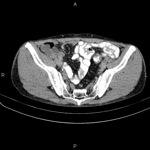Autoimmune pancreatitis (Radiopaedia 84925-100431 Axial C+ delayed 75).jpg