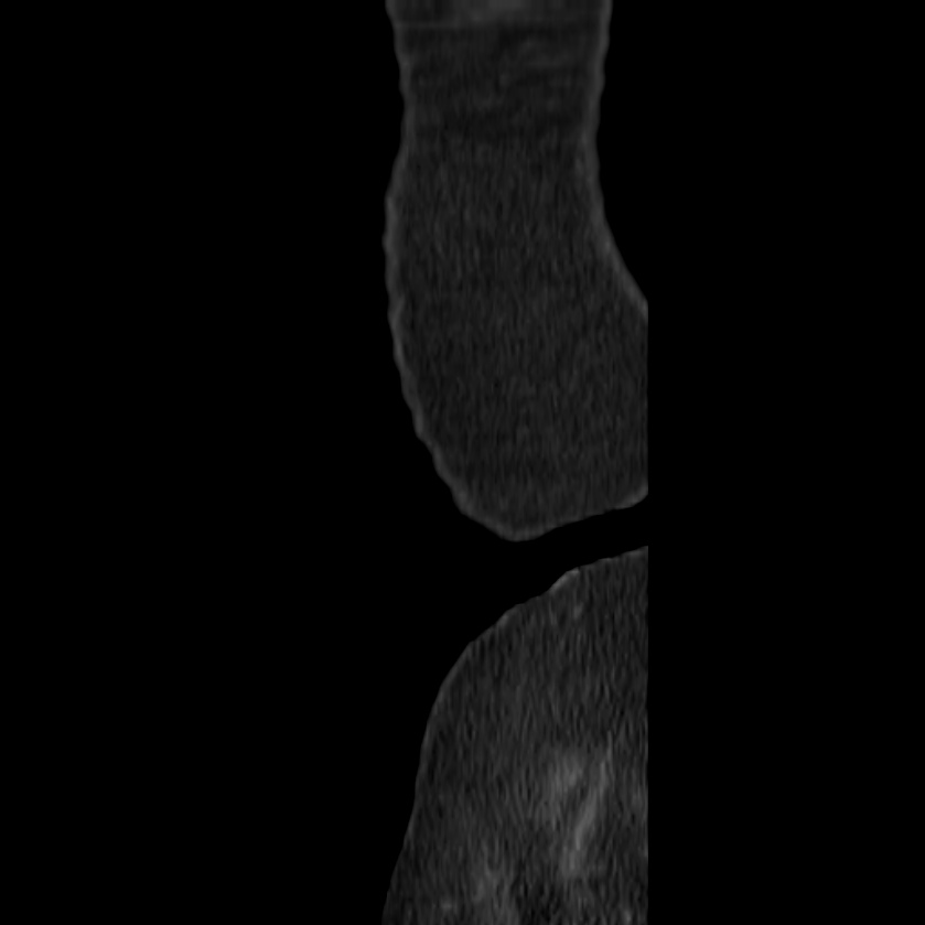 Autosomal dominant polycystic kidney disease (Radiopaedia 23061-23093 F 57).jpg
