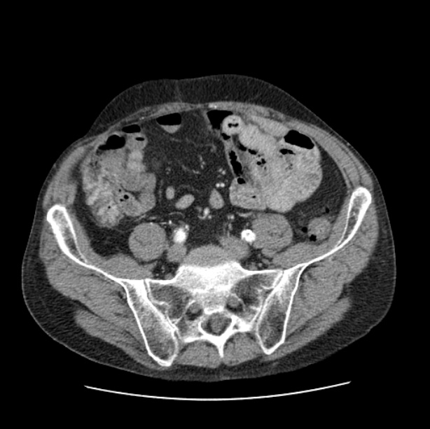 Autosomal dominant polycystic kidney disease (Radiopaedia 27851-28094 B 95).jpg