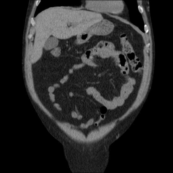 Autosomal dominant polycystic kidney disease (Radiopaedia 36539-38101 C 18).jpg