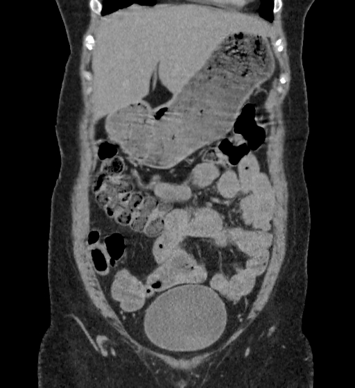 File:Autosomal dominant polycystic kidney disease (Radiopaedia 38189-40194 Coronal C+ delayed 12).jpg