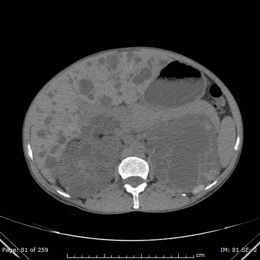 Autosomal dominant polycystic kidney disease (Radiopaedia 44122-47684 Axial non-contrast 29).jpg