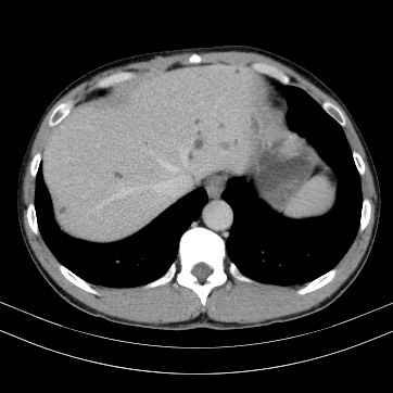 Autosomal dominant polycystic kidney disease (Radiopaedia 66349-75582 B 10).jpg